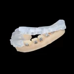 Colagem Indireta de Braquetes