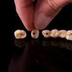 Coroa Provisória Sobre Implante