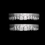 Enceramento Diagnóstico Estético para Mockup