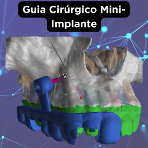 GUIA CIRÚRGICO PARA MINI‑IMPLANTE ORTODÔNTICO