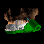 Guia Cirúrgico para Mini-implante Ortodôntico