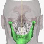 Cirurgia Ortognática: Guia + Planejamento Virtual