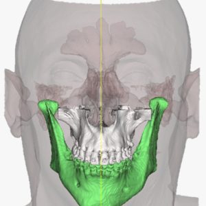 Cirurgia Ortognática: Guia + Planejamento Virtual