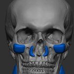 Prótese facial customizada