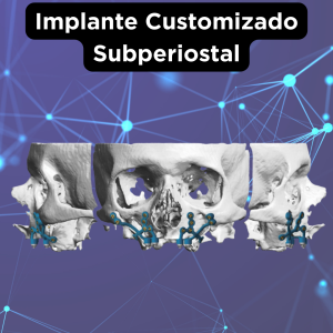 IMPLANTES CUSTOMIZADOS