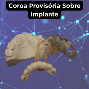 COROA PROVISÓRIA SOBRE IMPLANTE