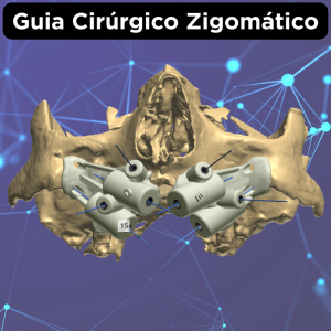 GUIA CIRÚRGICO PARA IMPLANTES ZIGOMÁTICOS